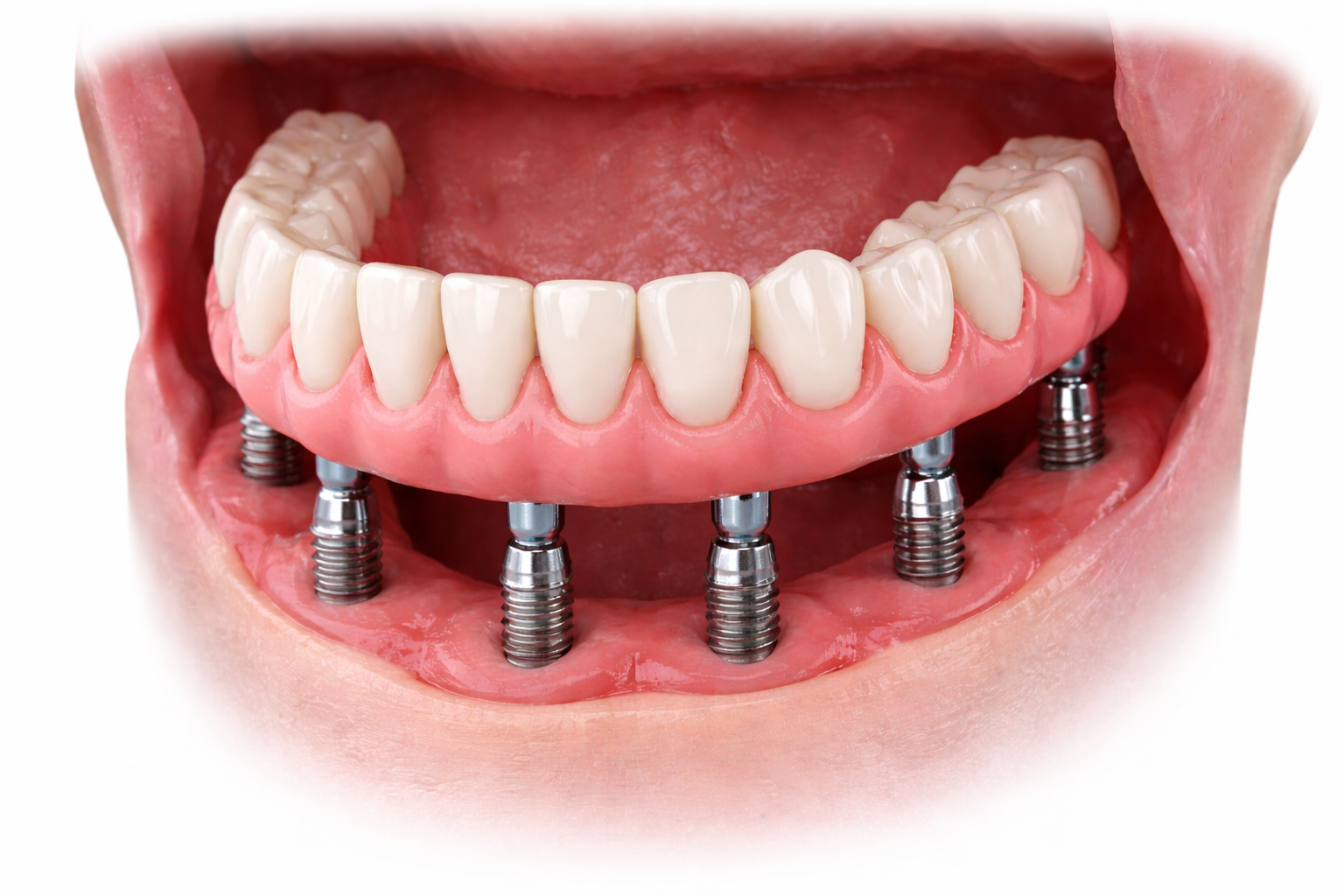 Dental Implants